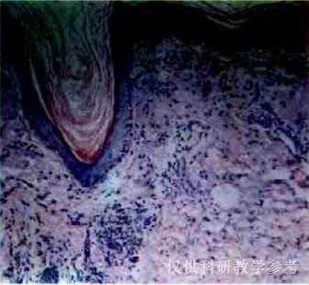 卟啉症患者图片,探寻罕见病的挑战与希望