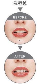 洗唇图片,洗唇术带你解锁唇部新魅力